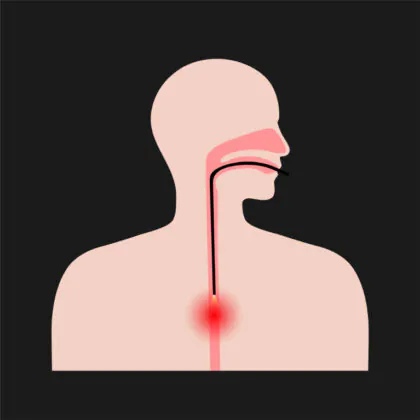 食道がんの早期発見
