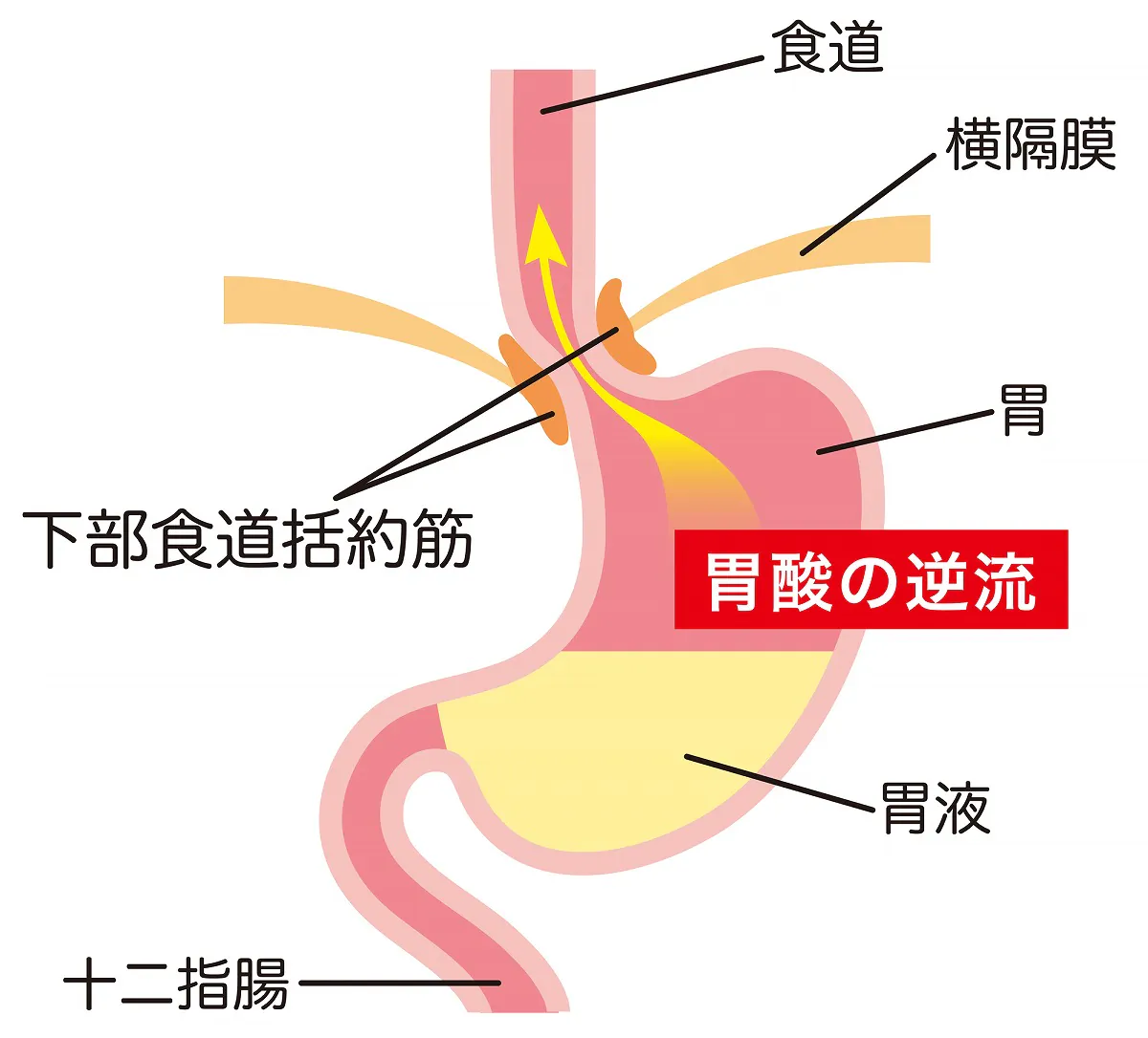 胃酸が逆流する「逆流性食道炎」とは