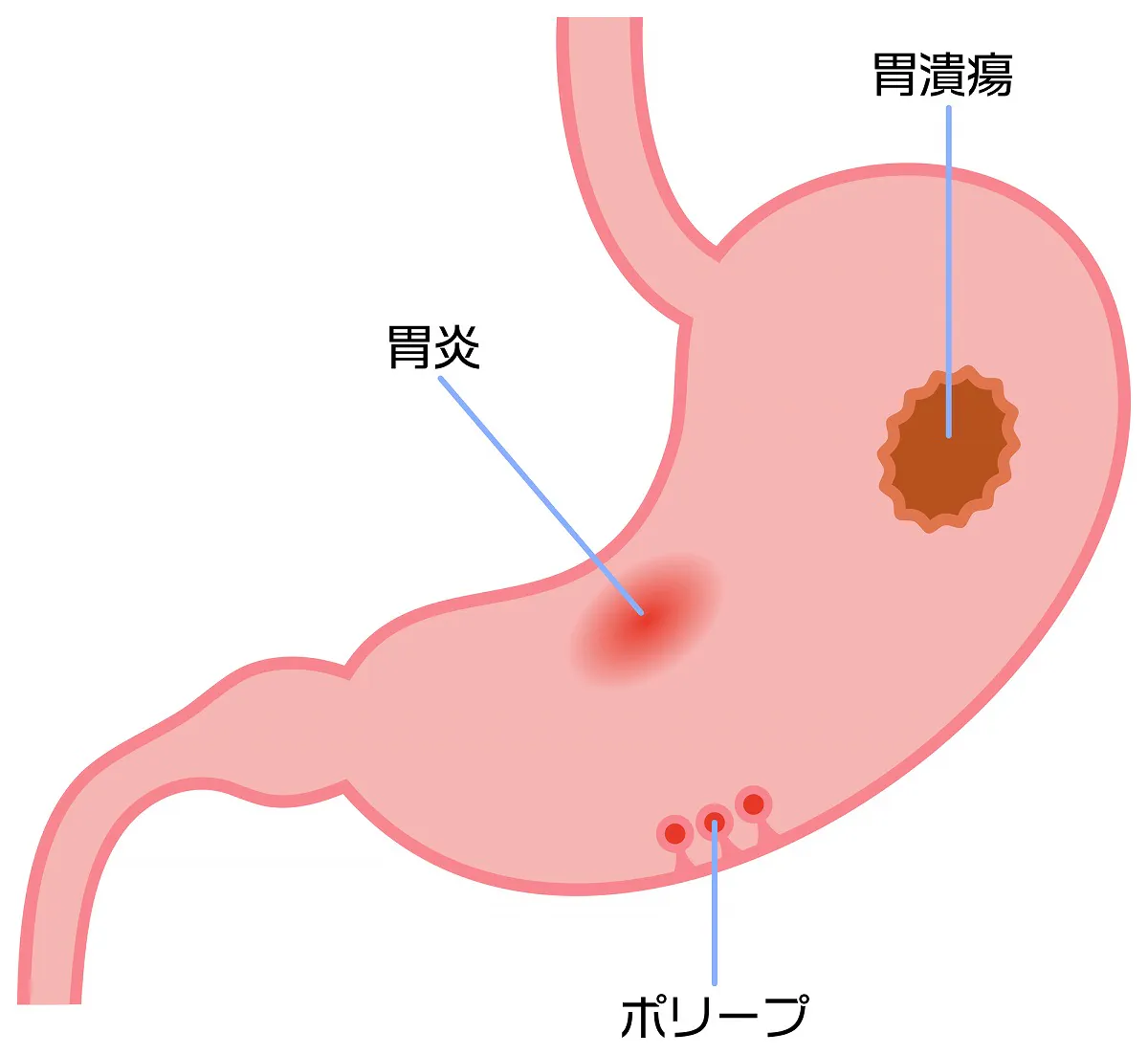 胃潰瘍とはどんな状態？